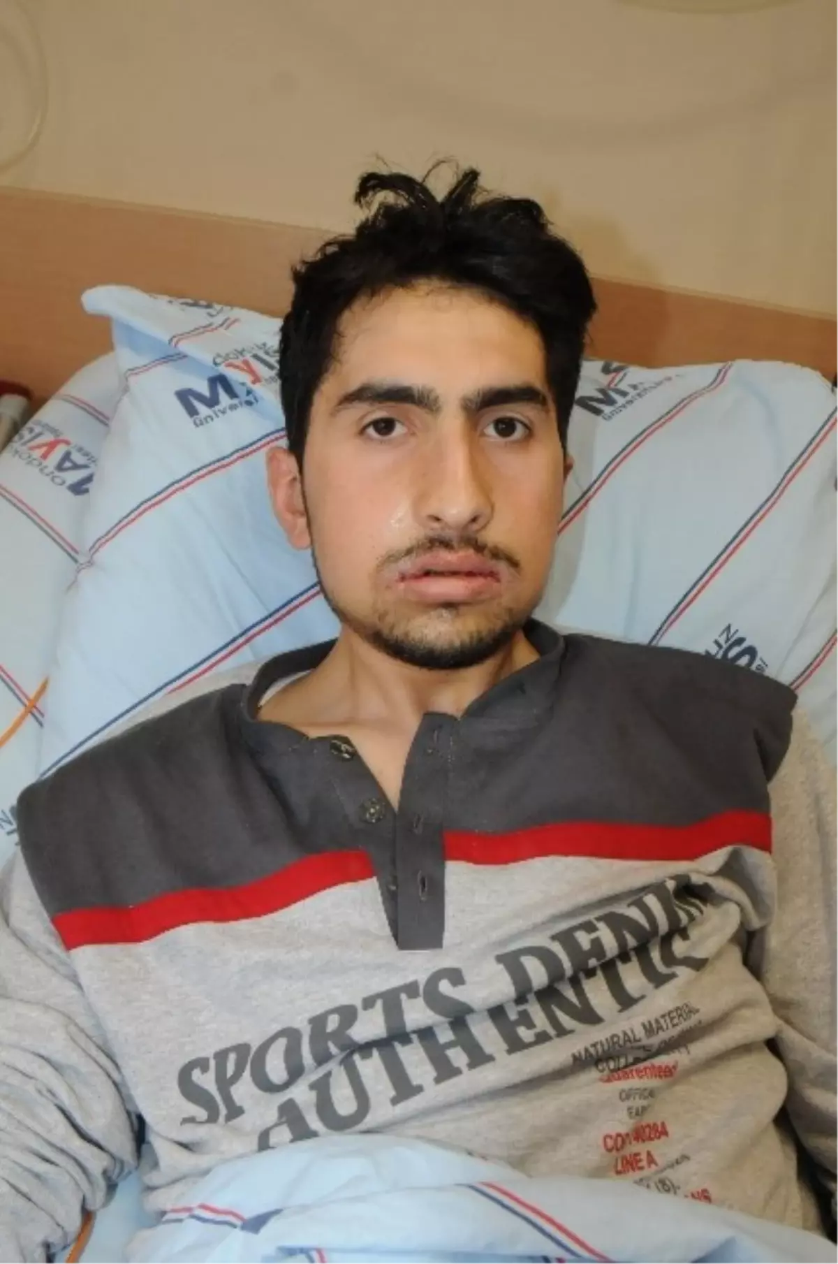 Çift Çene Ameliyatı