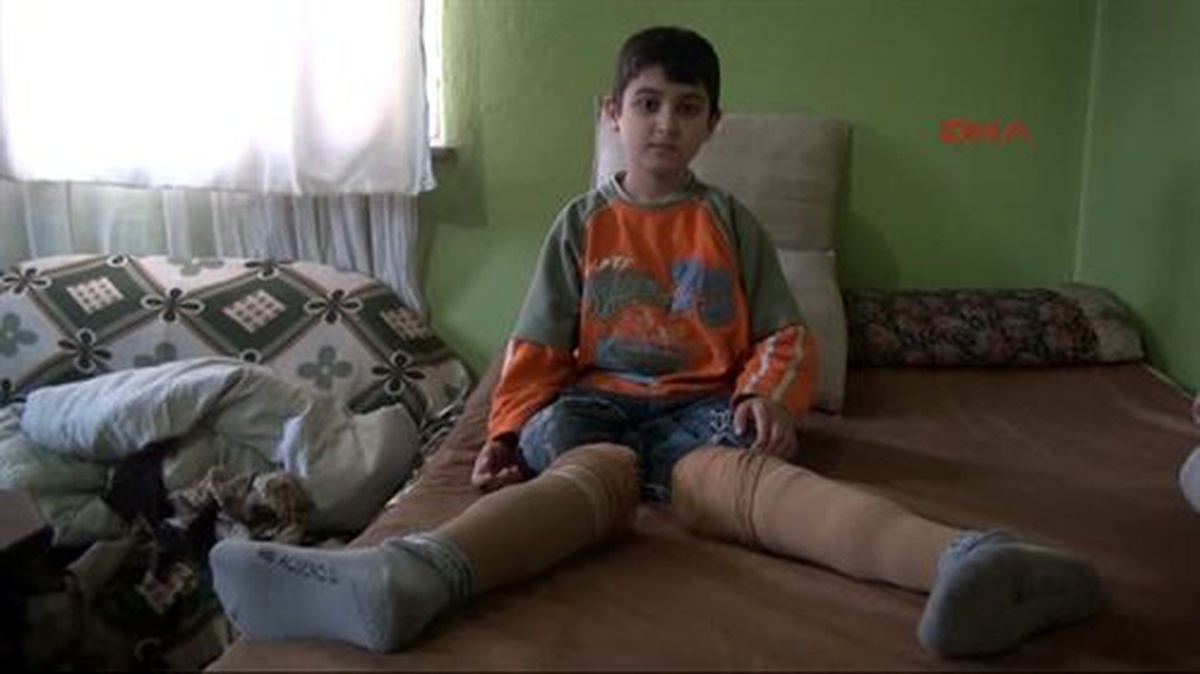 Ayaklarını Ot Biçme Makinesine Kaptıran Çocuğa Protez Bacak