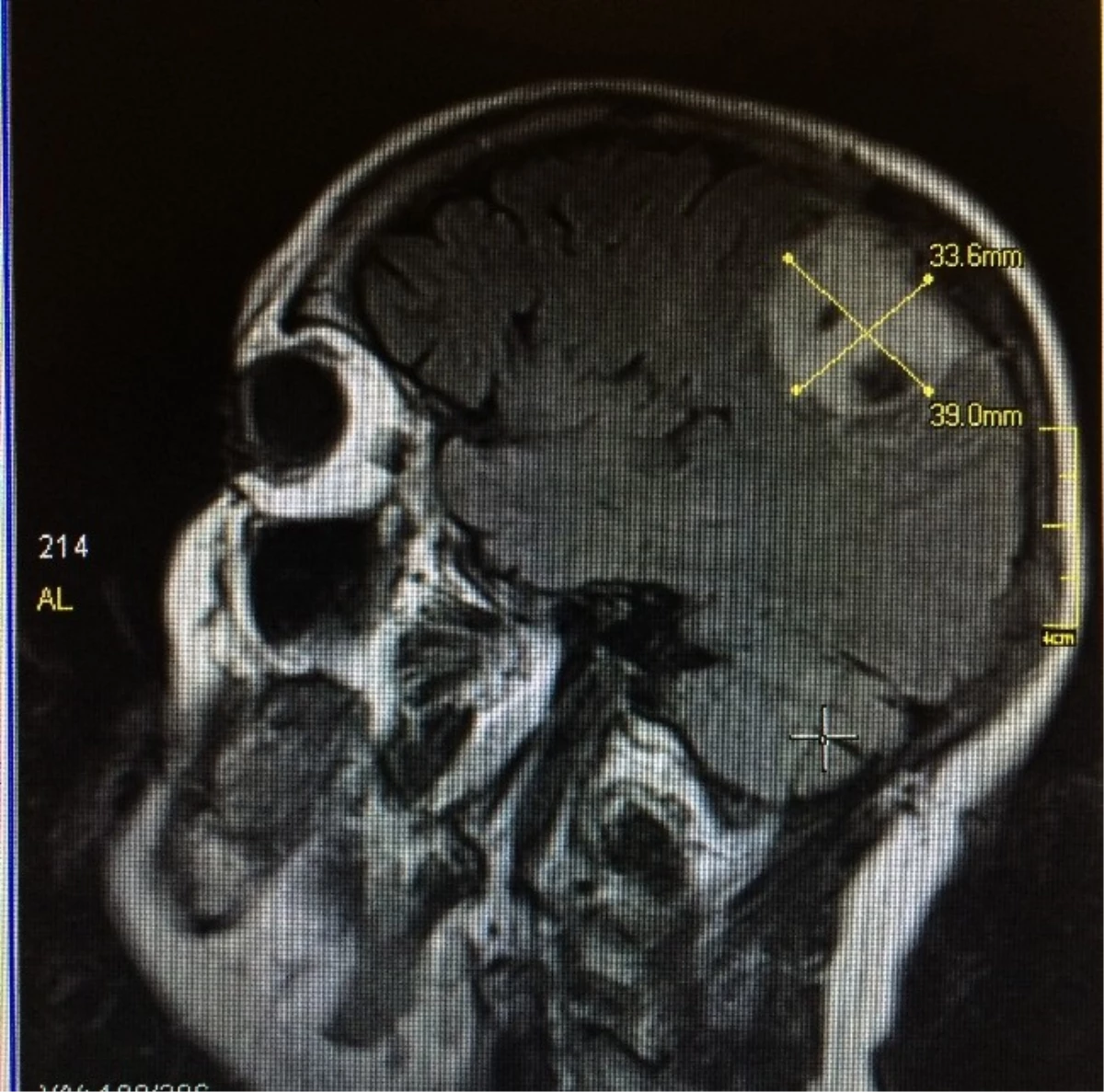Konuşa Konuşa Beyin Ameliyatı
