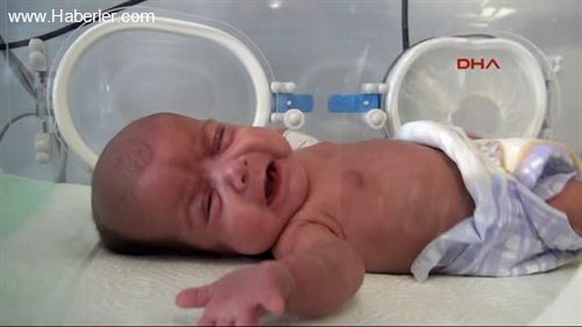 670 Gram Dünyaya Gelen Suriyeli Bebek Hayatta Tutundu