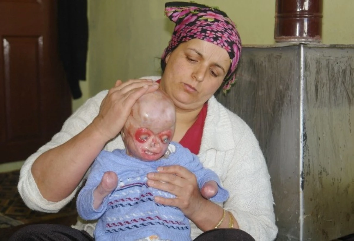 Yangında Gözlerini ve Ellerini Kaybeden Küçük Serkan Yardım Bekliyor