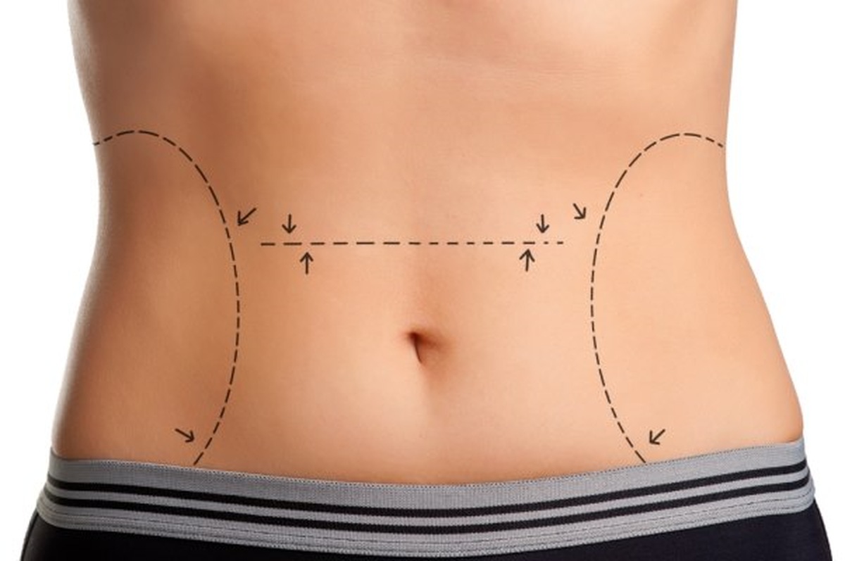 Abdominoplasti ile 30 Kilo Vermek ve 6 Beden İncelmek Mümkün
