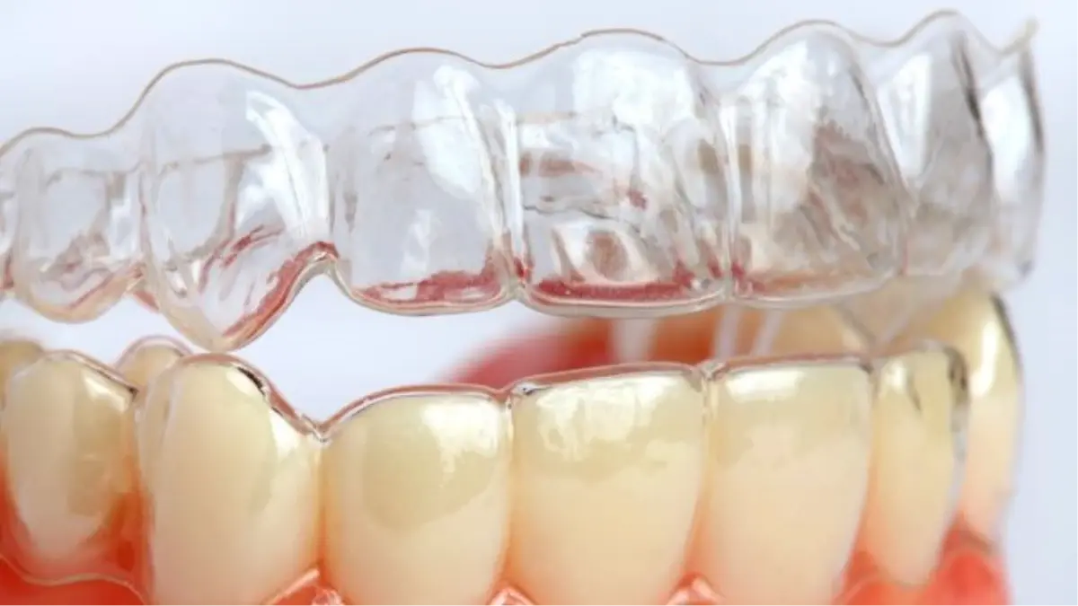 Tele Gerek Kalmadan Çarpık Dişler Tarih Olacak