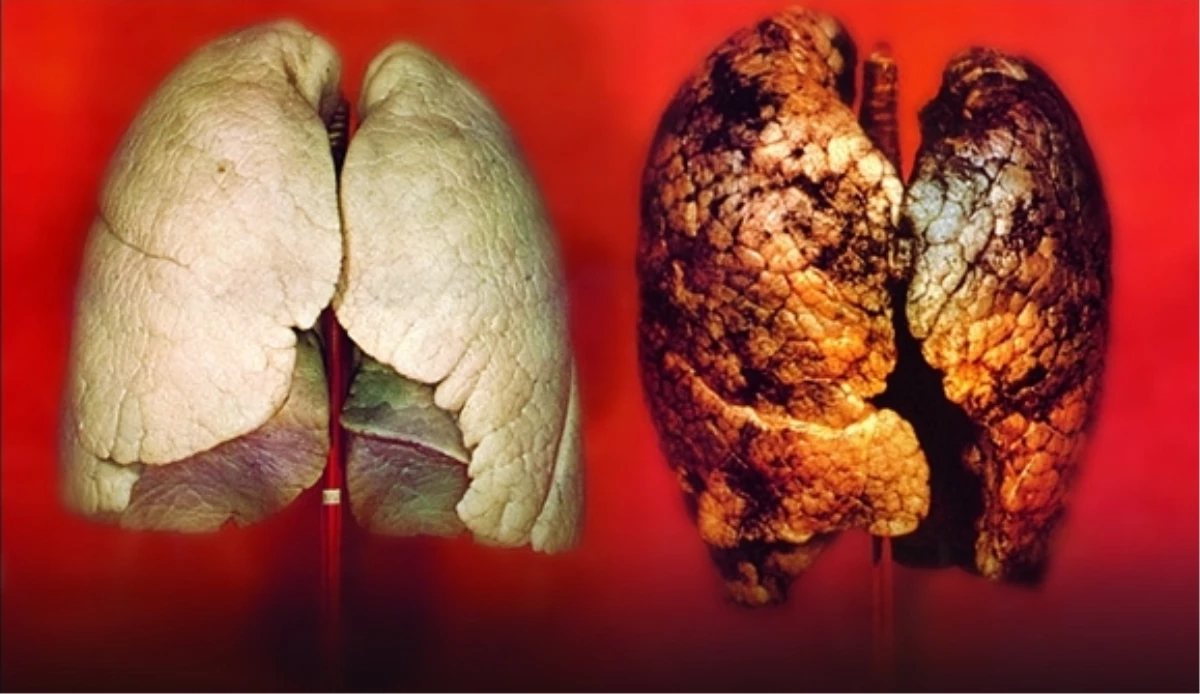 Türkiye\'de En Sık Görülen Kanser Türü Akciğer-Bronş Kanseri