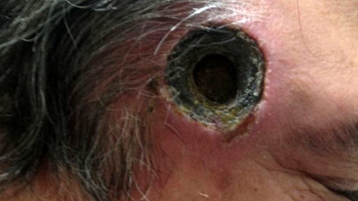 Kullandığı Kara Merhem, Yüzünde Kocaman Delik Açtı