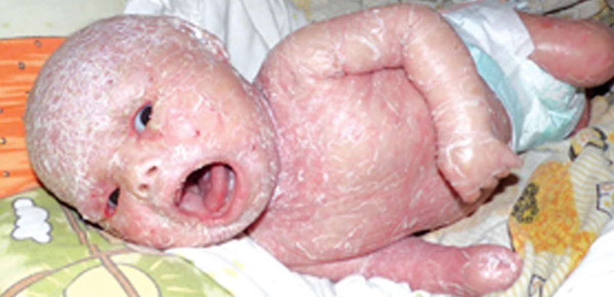 Derisi Olmayan Bebek