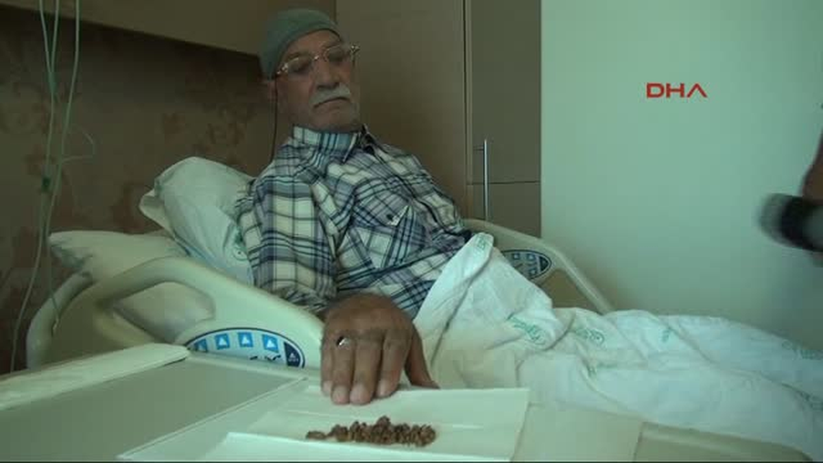 86 Yaşındaki Hastanın Mesanesinden 74 Adet Taş Çıktı