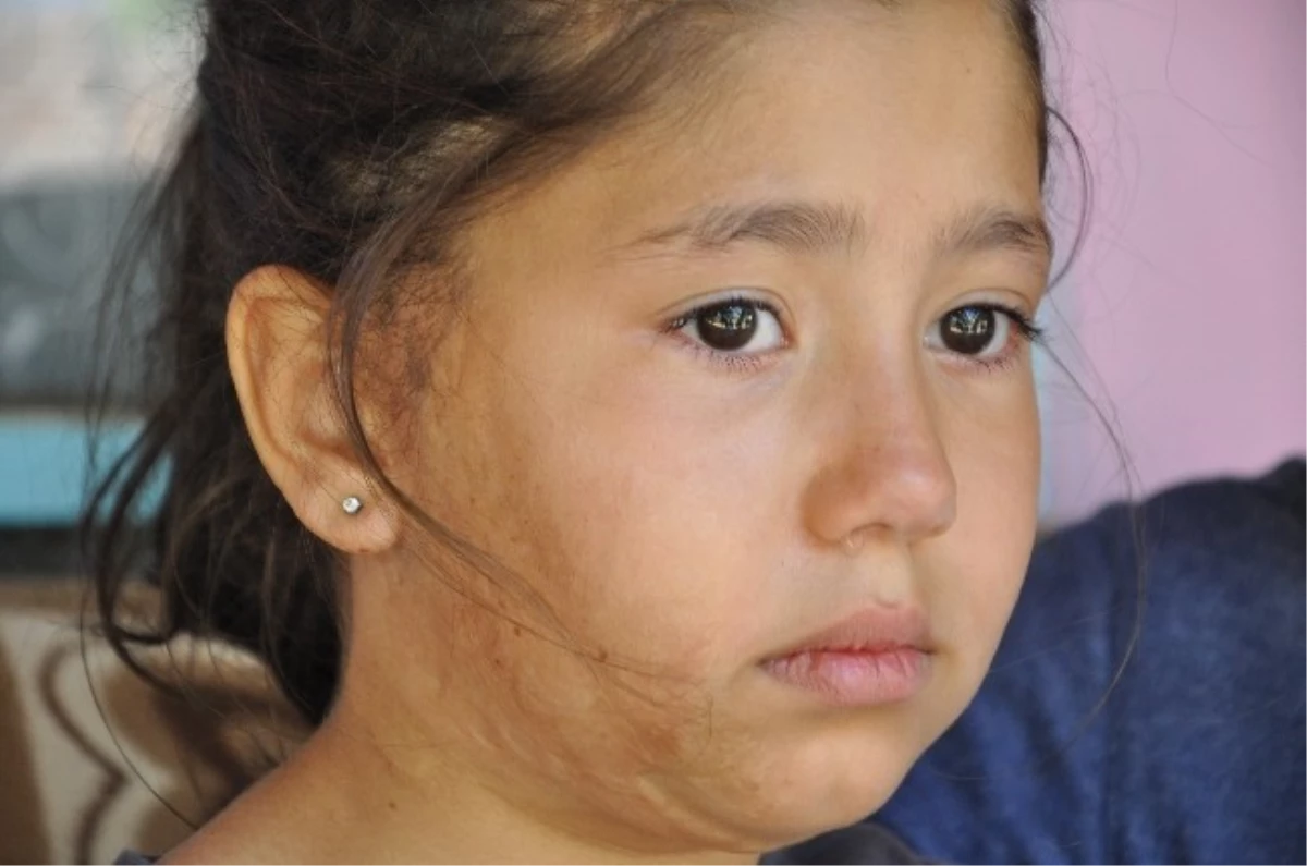 Yüzü ve Omzu Yanan Küçük Pınar Tedavi Olmak İstiyor