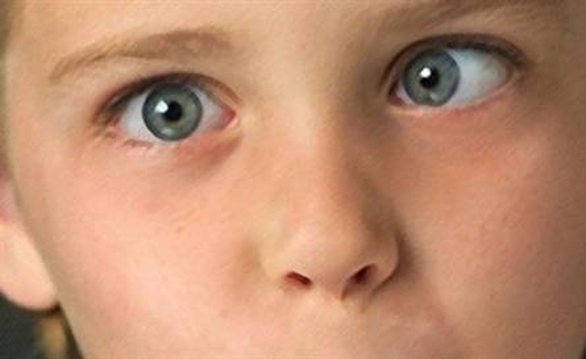Çocuklarda Şaşılık İhmale Gelmiyor