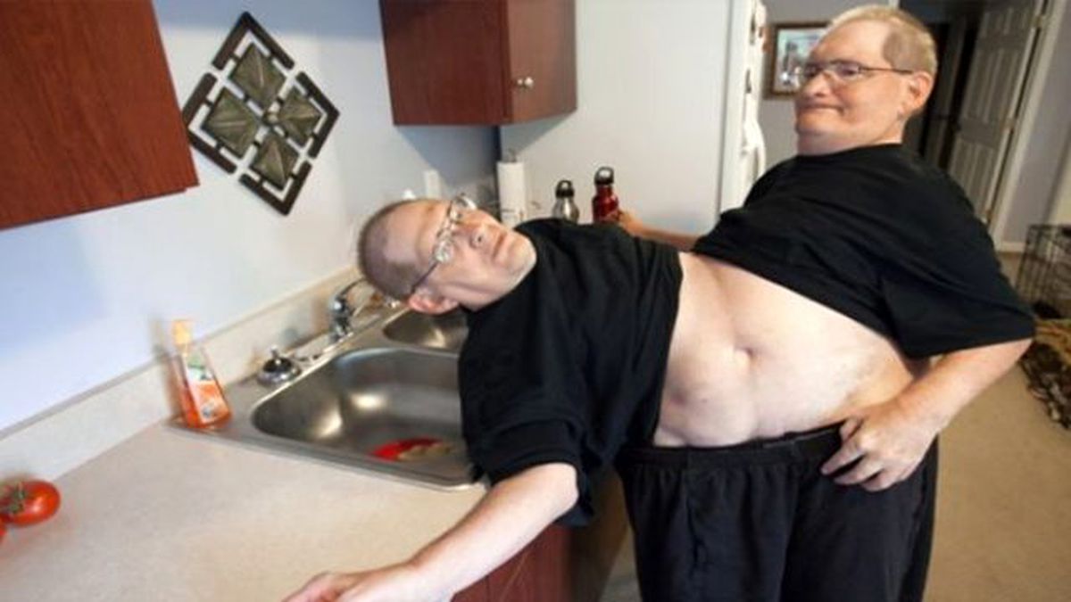 En Uzun Yaşayan Siyam İkizleri Olacaklar