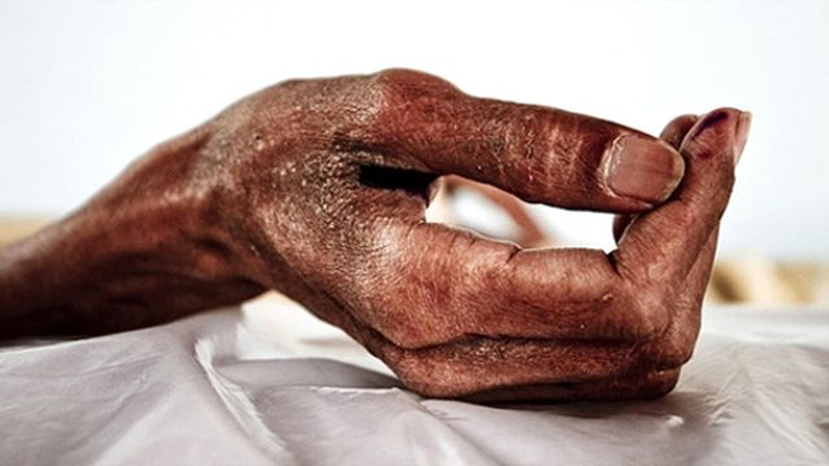 UNAIDS: Dünyada 35 Milyon Kişi HIV\'li Yaşıyor