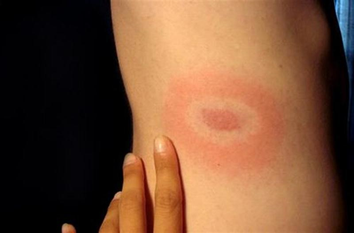 Biyoloji Profesöründen Lyme Hastalığı Uyarısı
