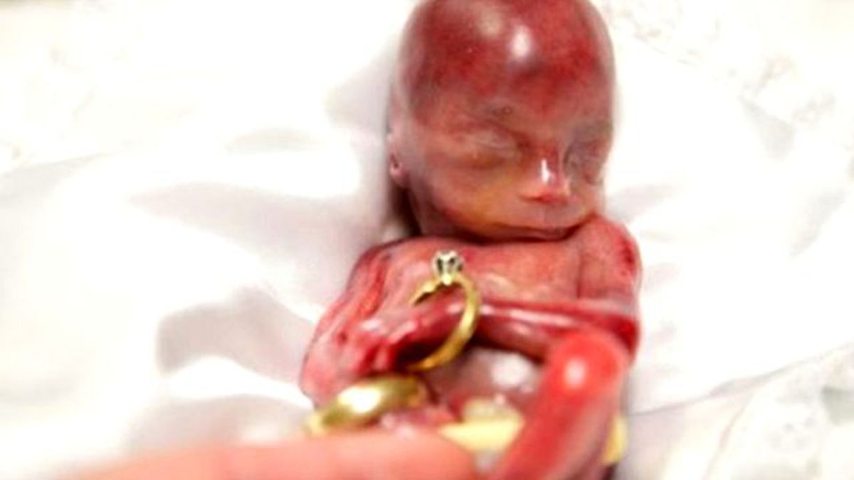 Sadece 1 Dakika Yaşayabilen Bebek: Walter Joshua Fretz