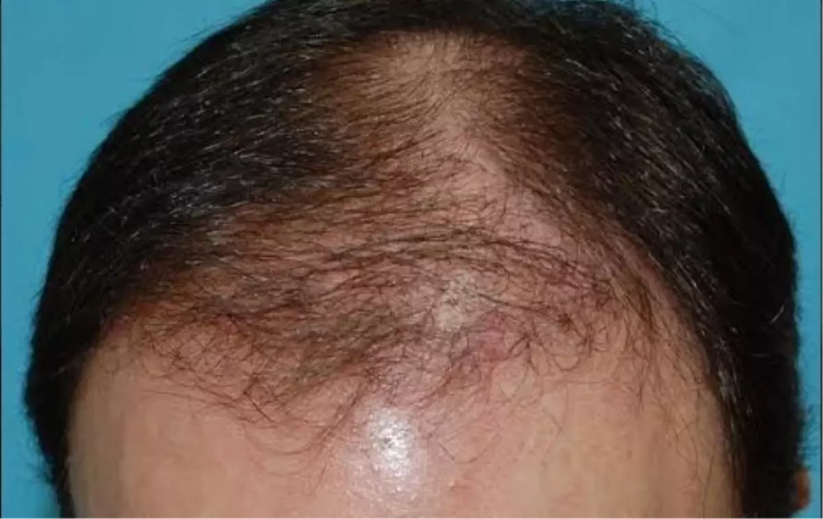 Yazın Saç Ekimi Olur Mu?