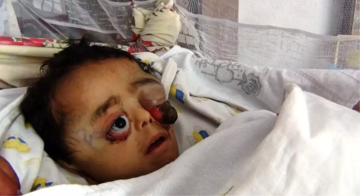 Tümör Nedeniyle Gözü Dışarı Fırladı