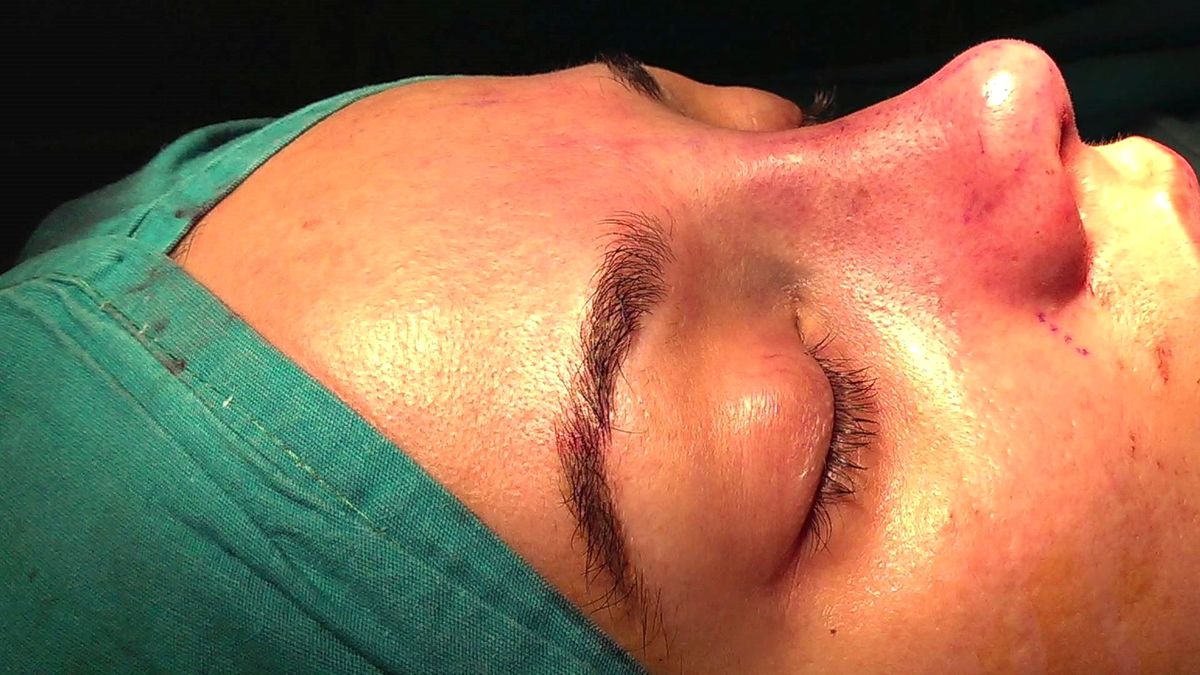 Bir Hekim Olarak Rinoplastide Hangi Tekniği Tercih Ediyorsunuz ? - Op. Dr. Mazhar Çelikoyar