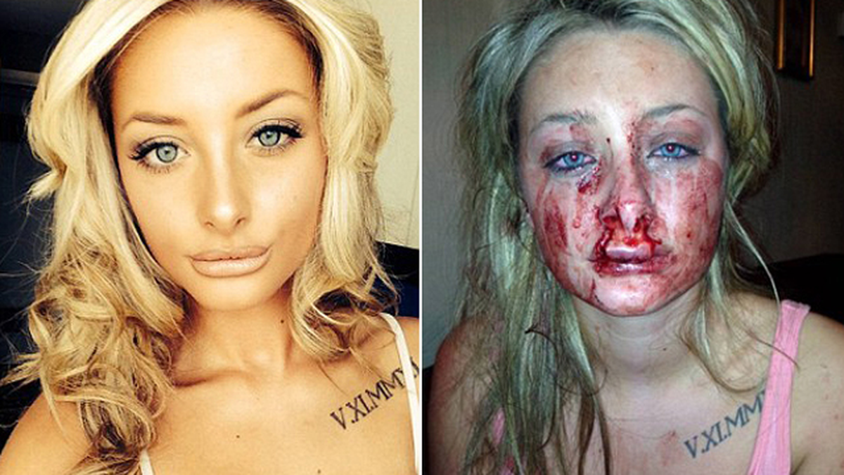 Sevgiliden Hastanelik Eden Öpücük