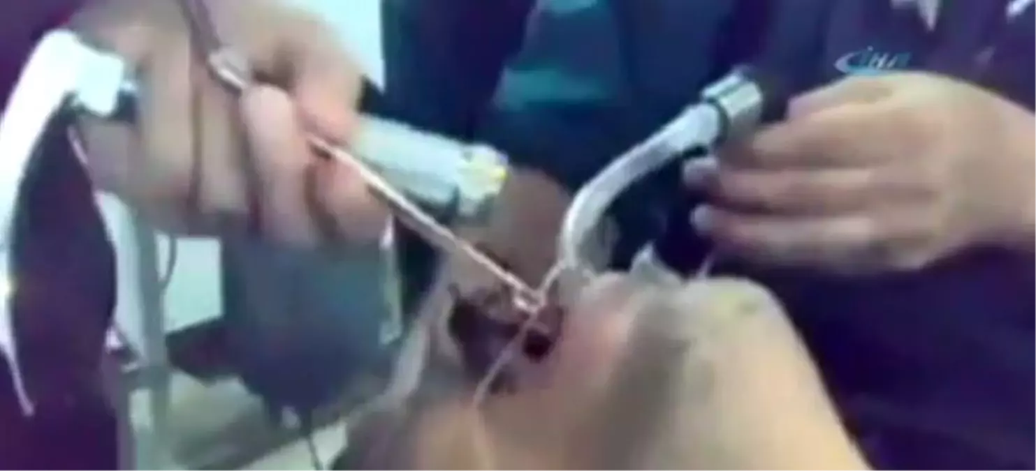 Midesinden Paslı Anahtar Çıktı