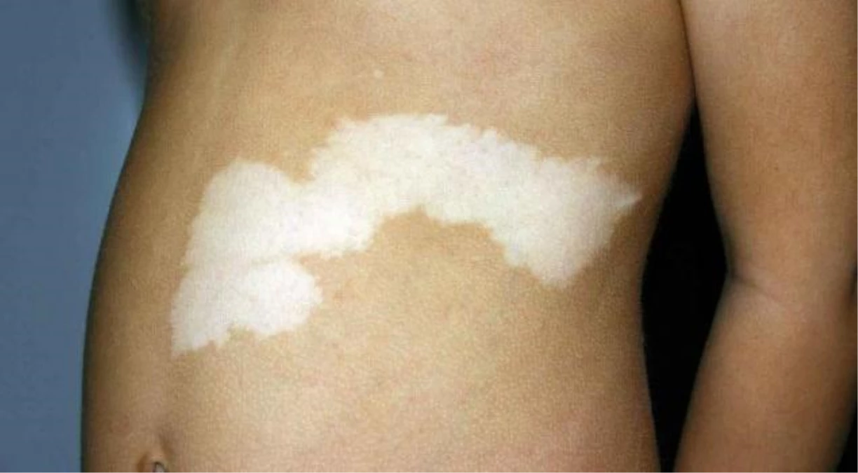 Vitiligo\'da İmmunoterapi Tedavisi Başarılı Sonuçlar Vermeye Başladı