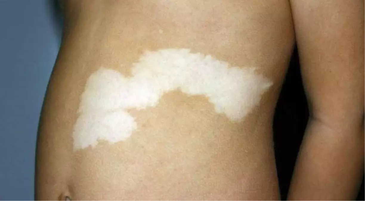 Vitiligo\'da İmmunoterapi Tedavisi Başarılı Sonuçlar Vermeye Başladı