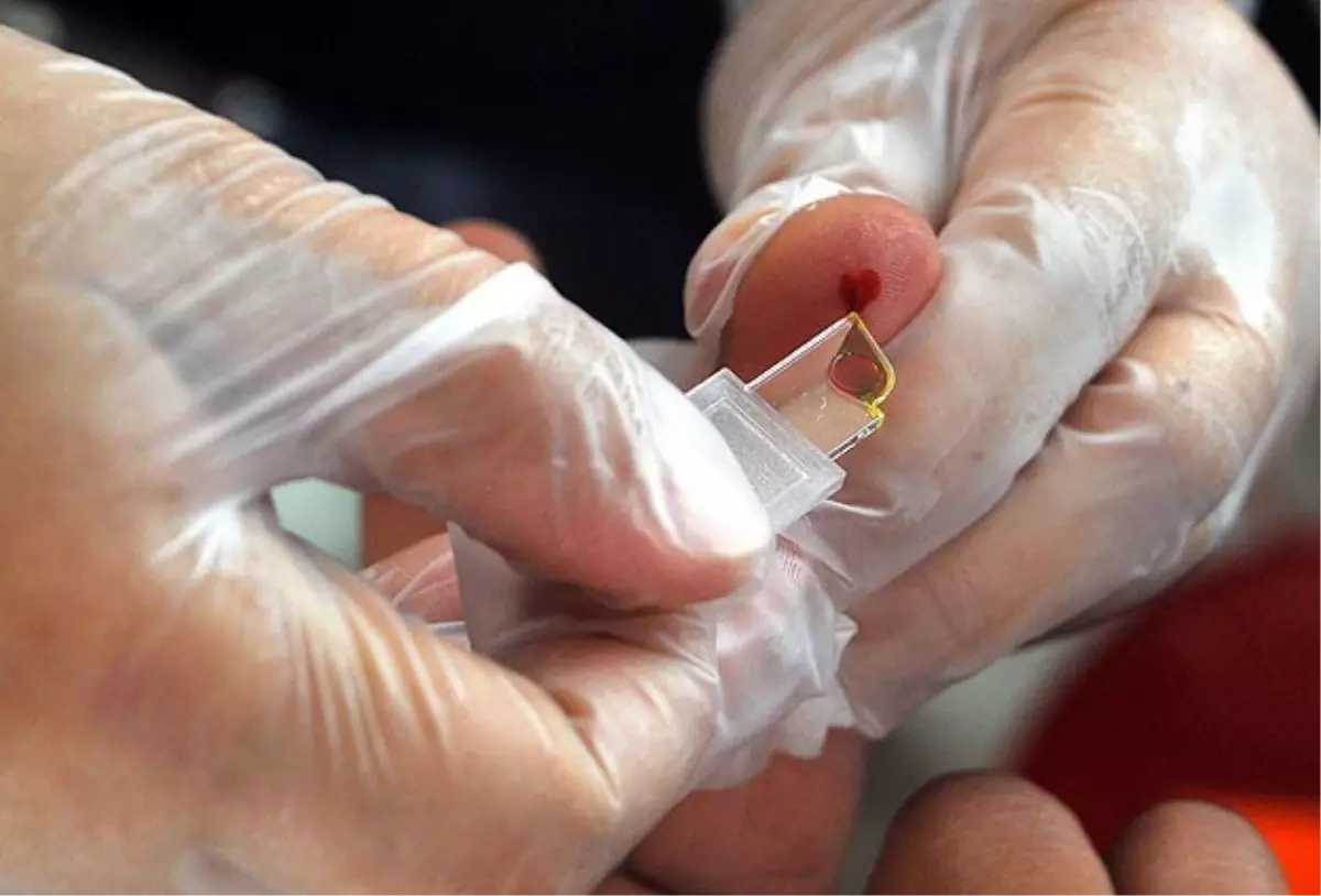 Kistik Fibrozise 'Tarama Testli' Çözüm