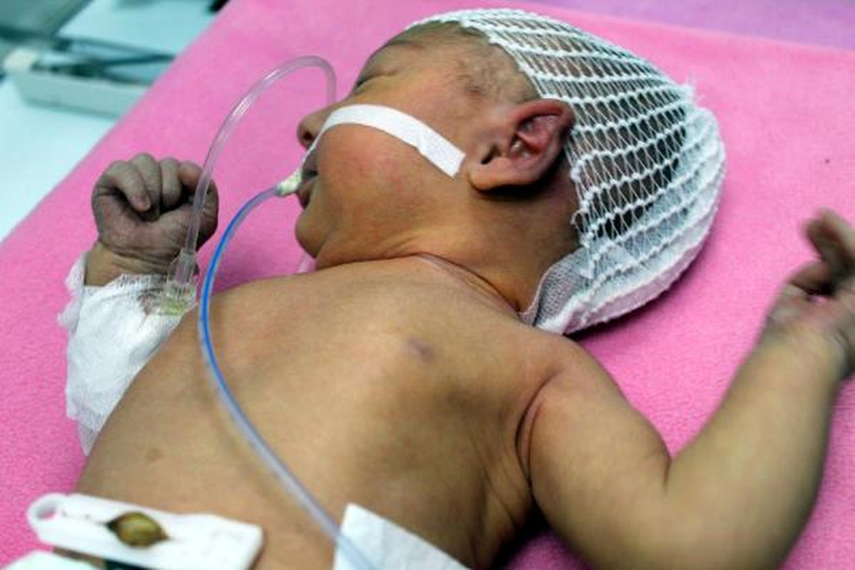 Başında 25 Santim Kistle Doğan Bebeğe Ameliyat