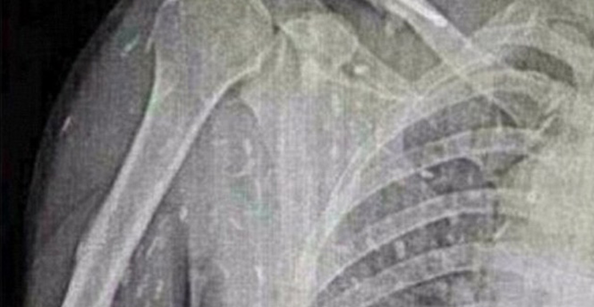 Suşi Yüzünden Tüm Vücudu Kurt Oldu