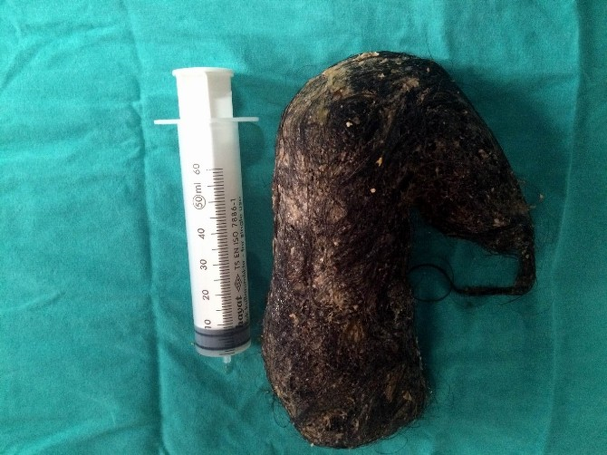 Yediği Saç Kılları Midesinde Kocaman Yumak Oldu