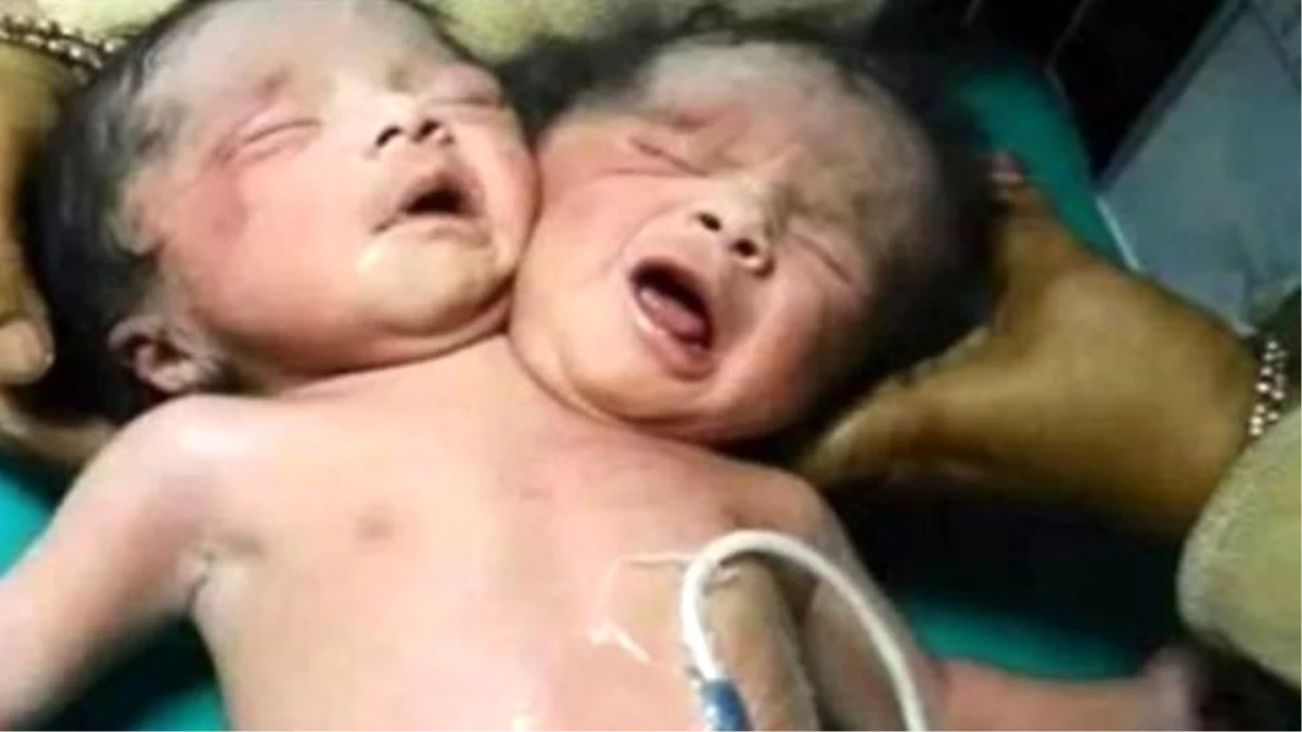 İki Başlı ve Üç Kollu Bebek Doğuran Anne, Hastaneyi Terk Etti