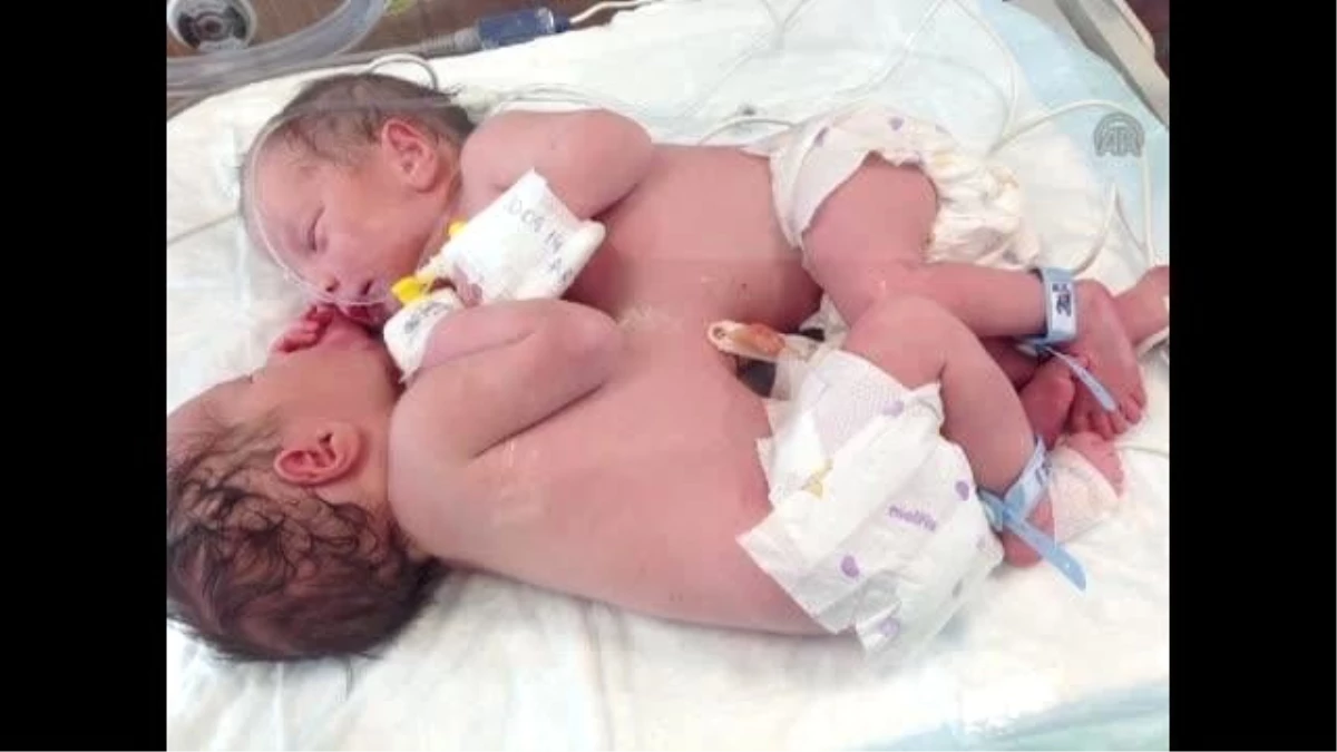 Siyam İkizleri Ameliyatla Ayrıldı