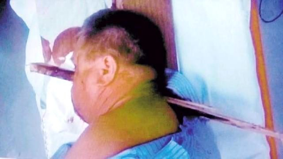 Yüzünde 40 Santimlik Tahta Kazıkla Hastaneye Gitti