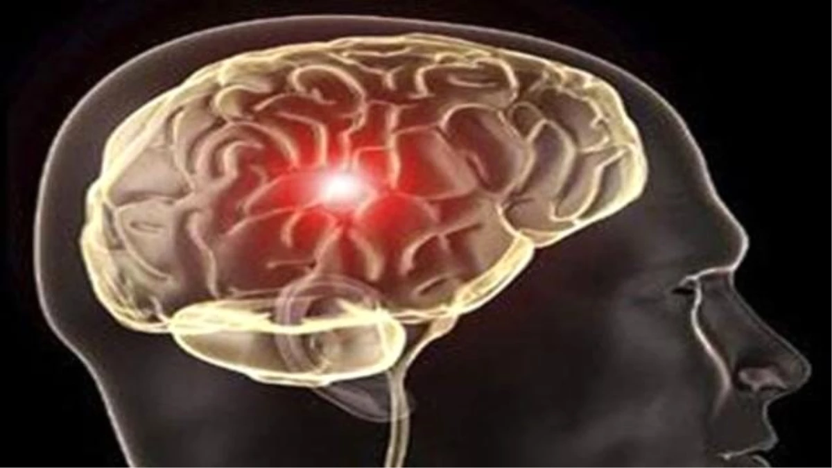 Beyin Pili ile 90 Derecelik Kamburluktan Kurtuldu