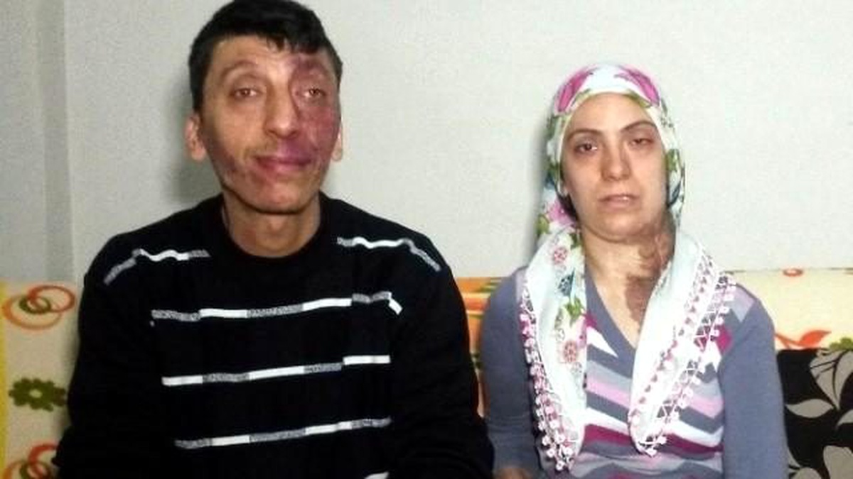 Yüzlerinde Doğuştan Yara Olan Kardeşlerin Tek İsteği, Evlenmek