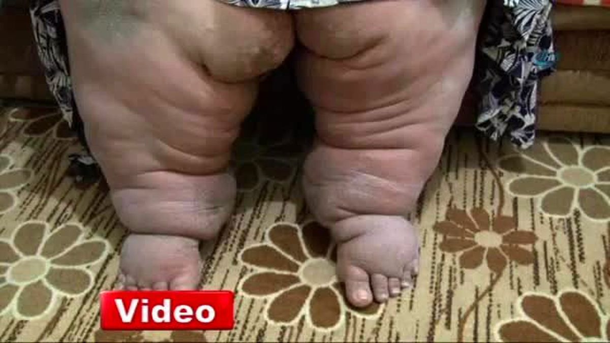 Fil Hastası Kadın, Evden Dışarı Çıkamıyor