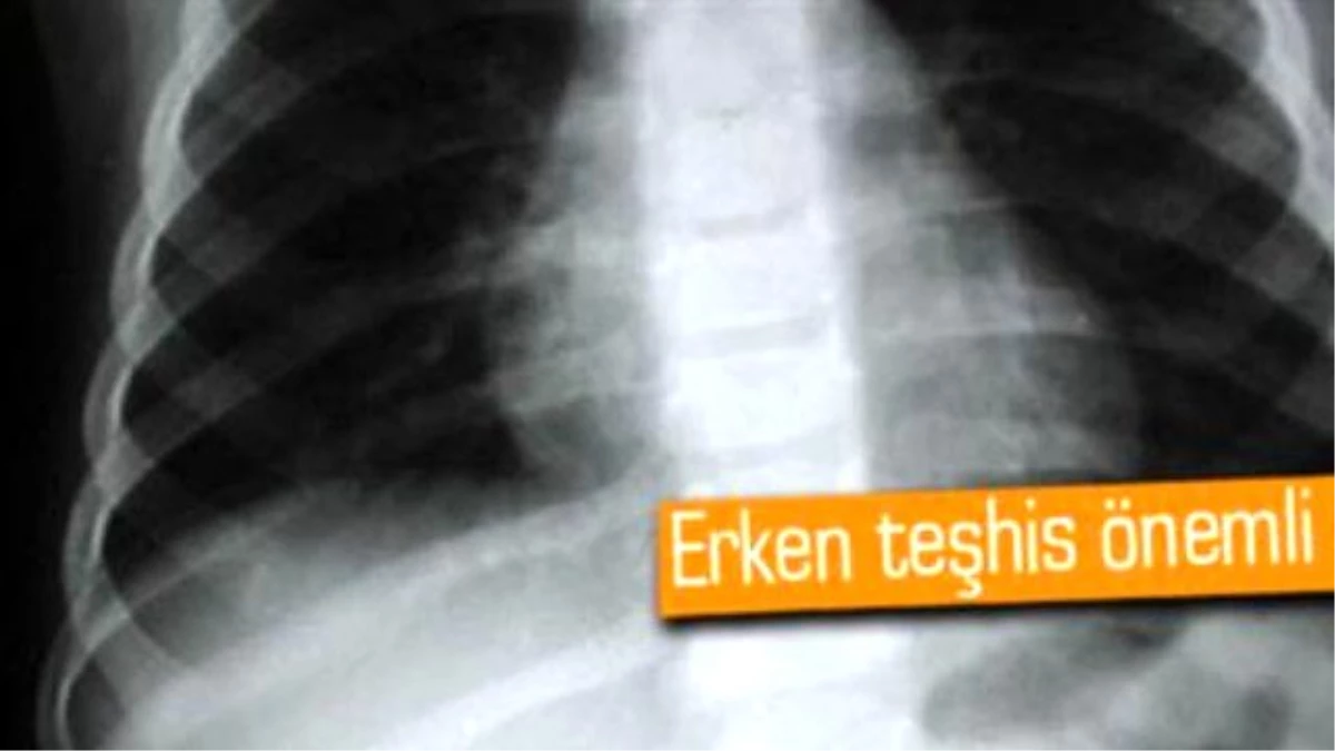 Akciğer Kanserinde Erken Teşhis İmkanı: E-Burun
