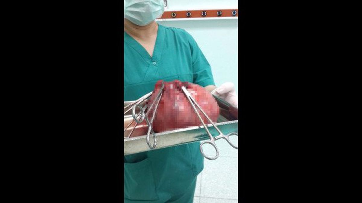 Rahminden Dört Kiloya Yakın Cisim Çıkarıldı