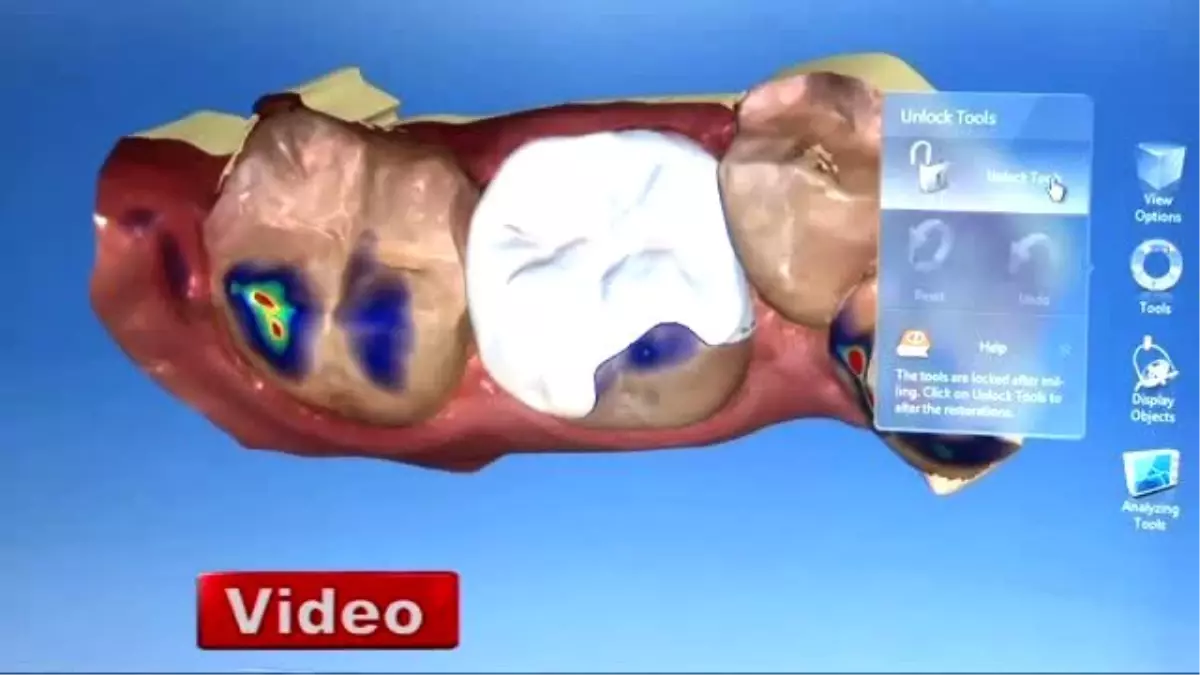 Dijital Diş Hekimliği ile Kaplama ve Dolgu Tek Seansta Hastaya Teslim Ediliyor