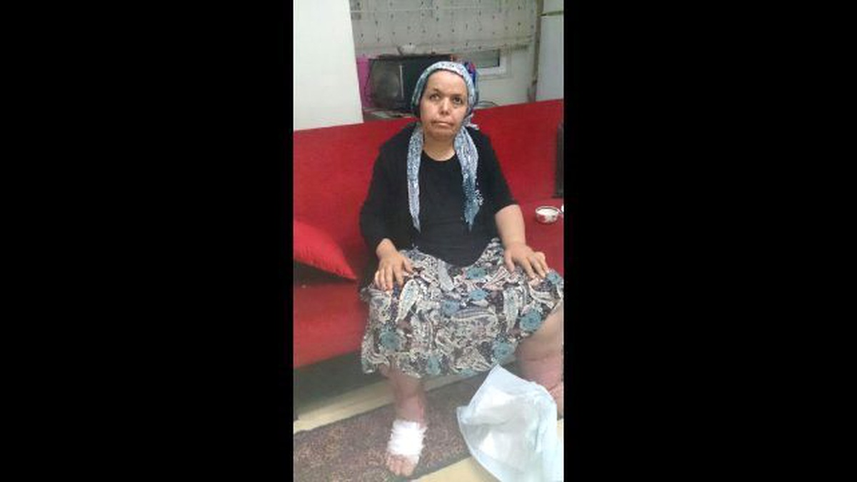 Fil Hastası Kadının Çaresizliği