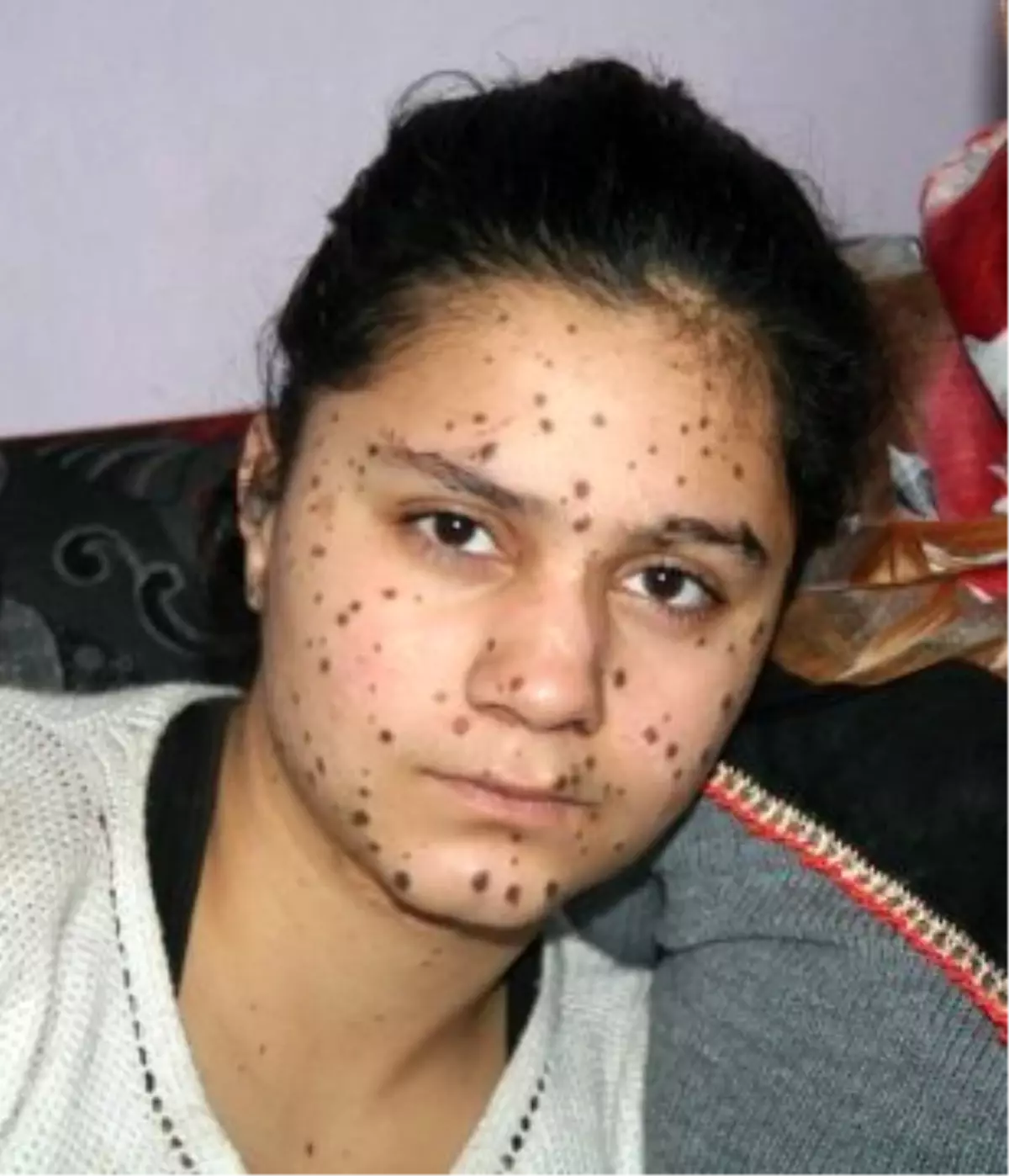 Cilt Kanseri Olan Genç Kızın Feryadı: Kurtarın Beni