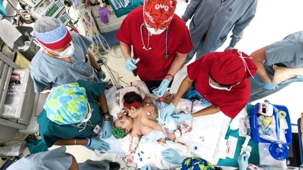 Siyam İkizleri 26 Saatlik Operasyonla Ayrıldı