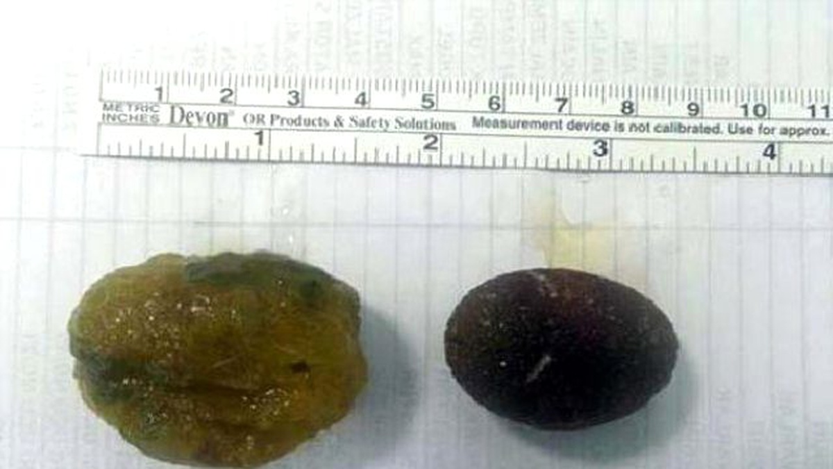 Yaşlı Kadının Bağırsağından Taşlaşmış Yiyecek Kalıntısı Çıktı