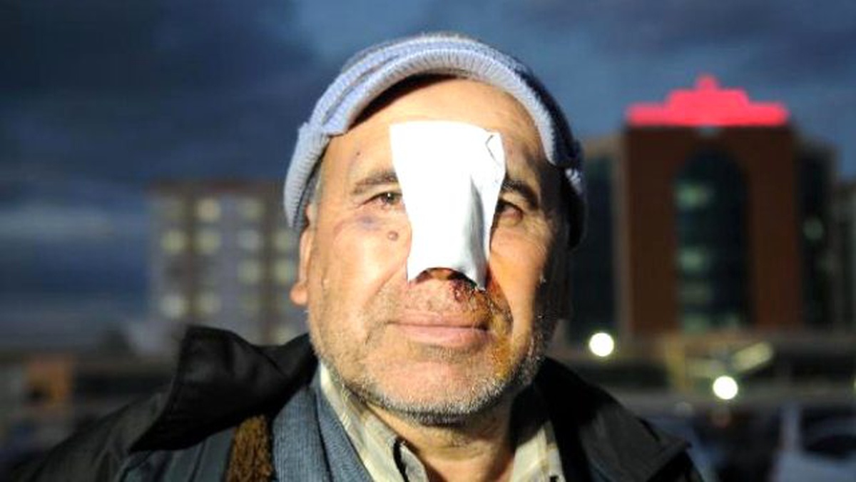 Hastane Dolaştı Ama Burnundaki Yaraya Dikiş Attıramadı