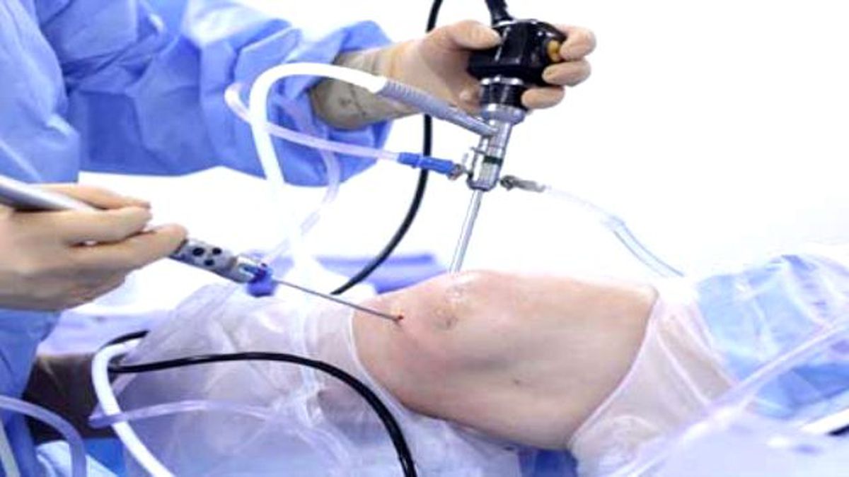 Artroskopik Cerrahi İle Mozaik Plasti Tedavisi