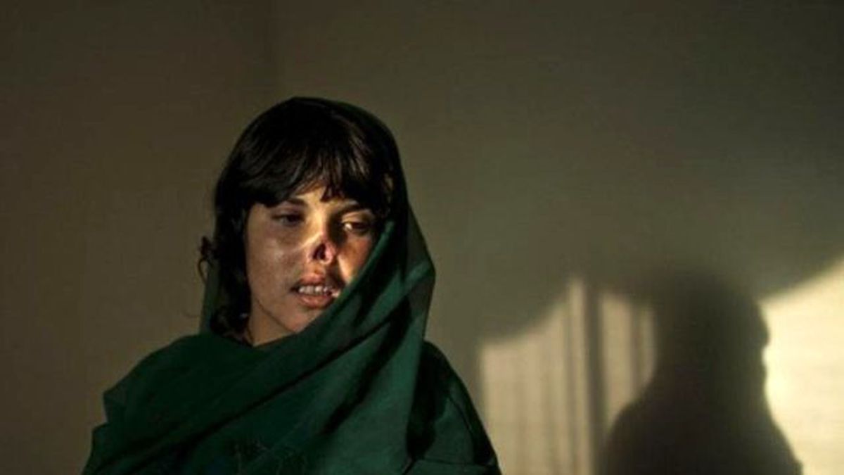 Kocası Tarafından Burnu Kesilen Afgan Kadın Yeni Burnuna Kavuştu