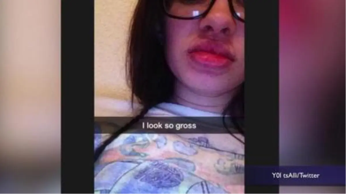 Kylie Jenner Lip Challenge' Leaves Terrifying Results