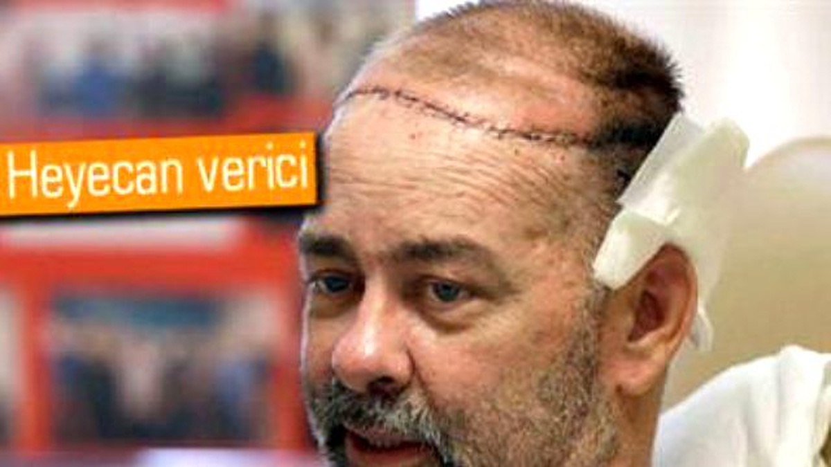Dünyanın İlk Kısmi Kafatası Nakli Yapıldı
