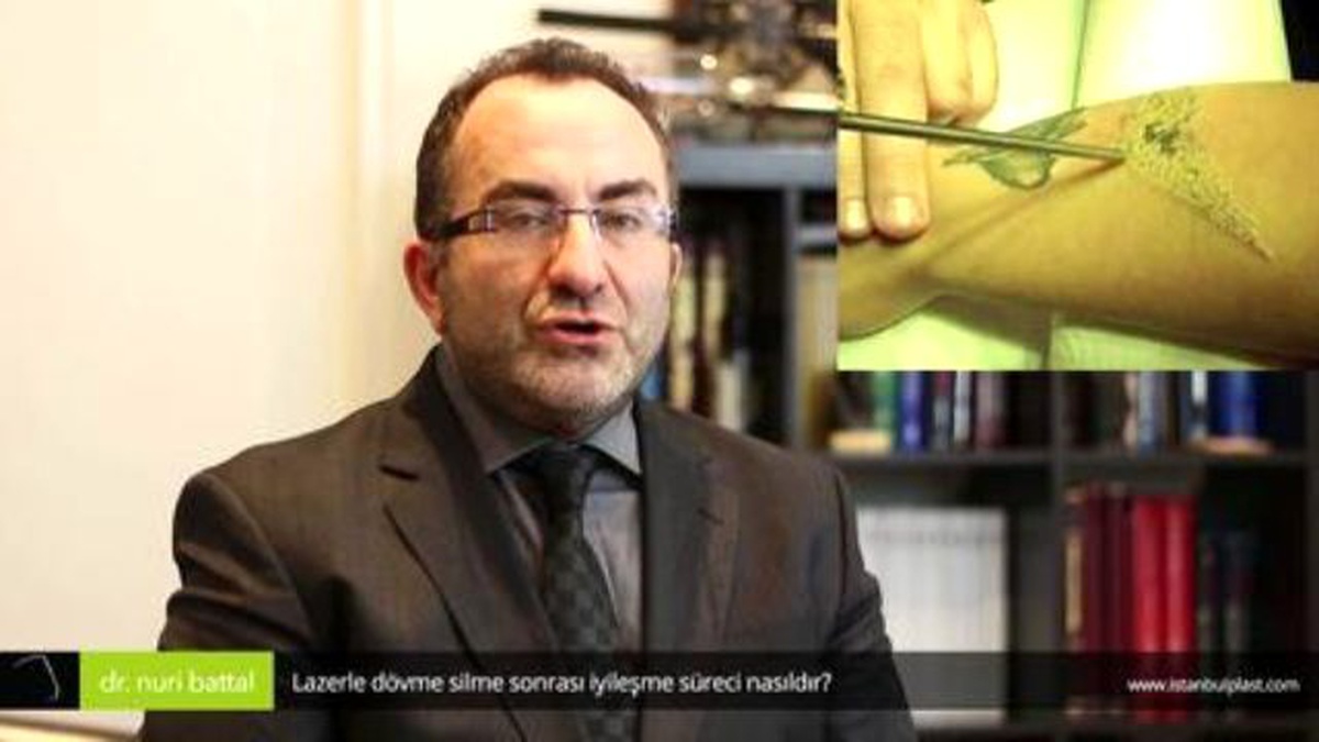 Lazerle Dövme Silme Sonrası İyileşme Süreci Nasıldır? - Op. Dr. Nuri Battal
