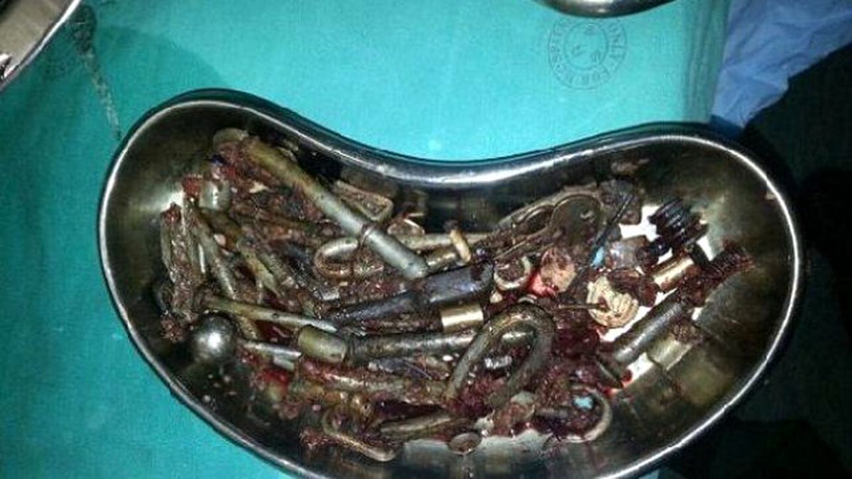 Midesinden 227 Tane Metal Parça Çıktı