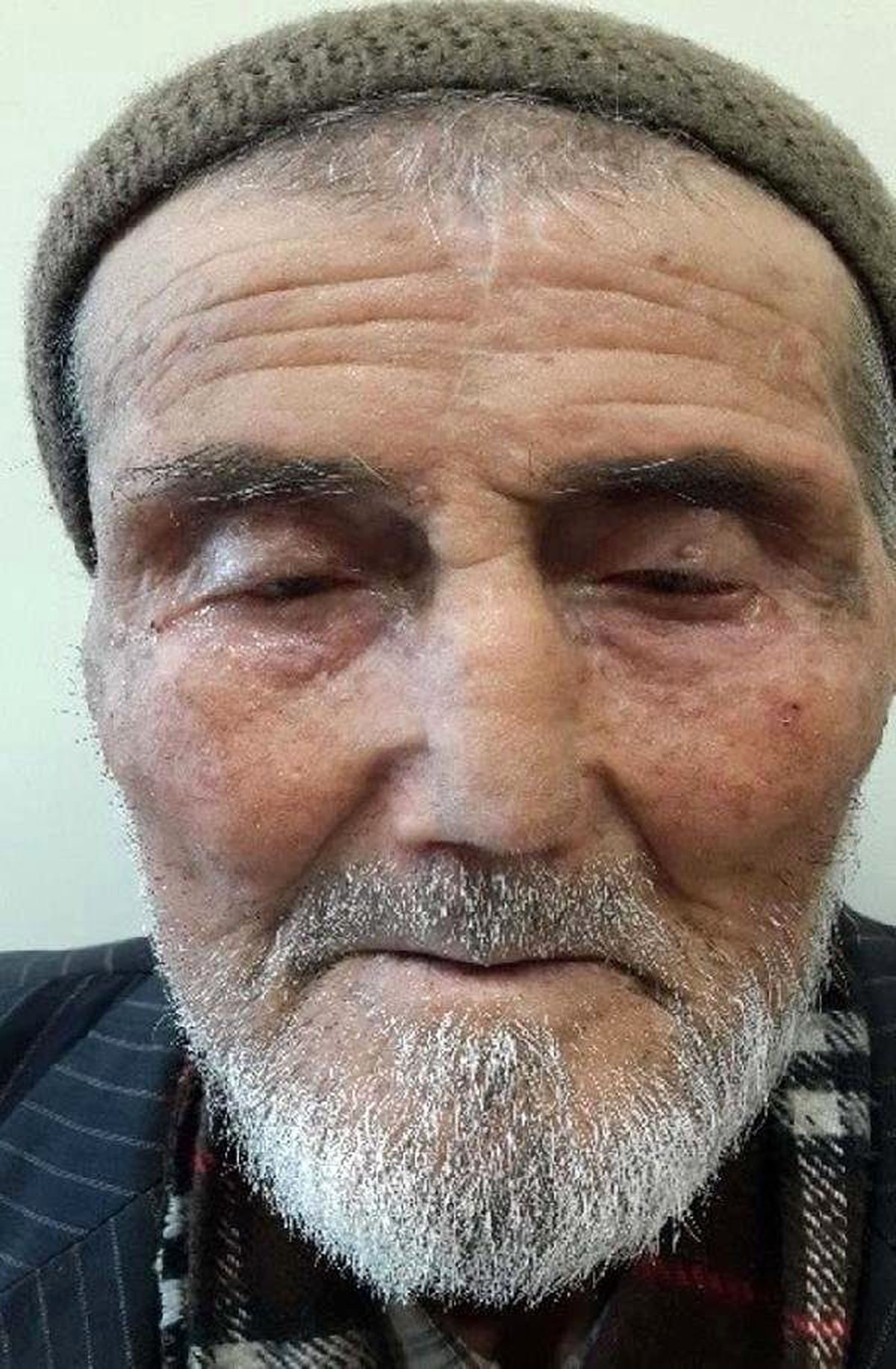 Yaşlı Hastaya Alnından Alınan Dokuyla Burun Yapıldı