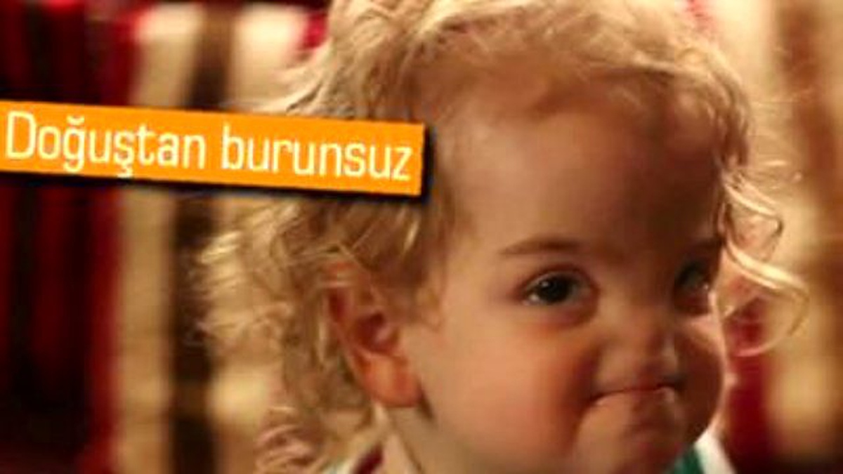 3d Yazıcıyla Yeni Burna Sahip Olacak